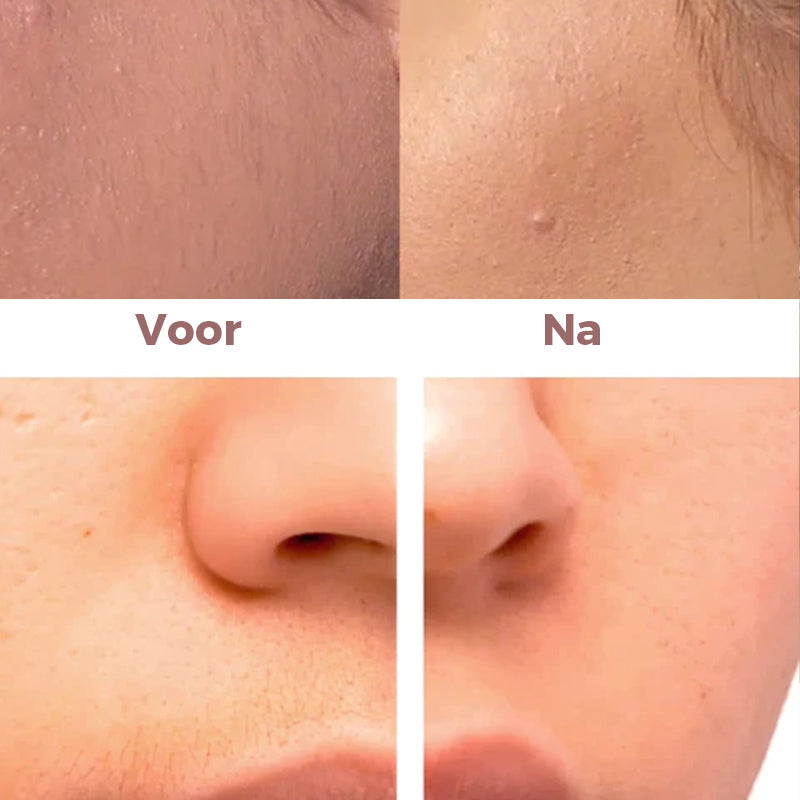 Norvo | Epilator