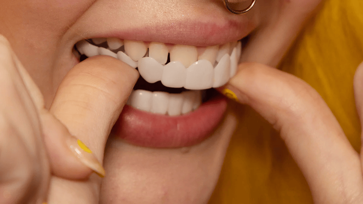 Norvo | Umiddelbar Smile Transformasjon med Snap on Smile Filler