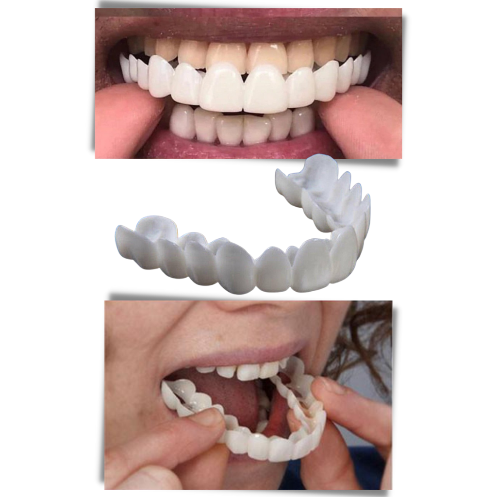 Perfekt smil tanndekning - komfortable finér