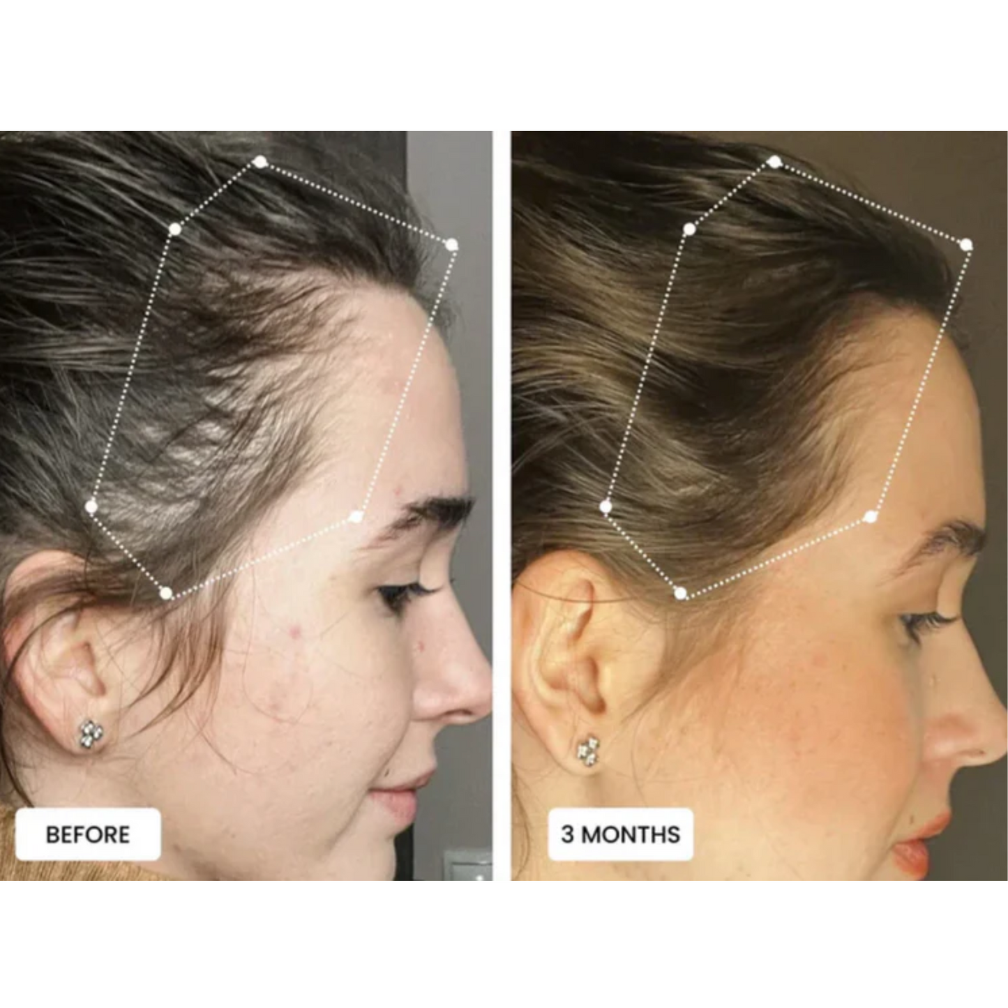 Norvo | Hodebunnsmassasjebørste med Rød Lysterapi | Fremmer Hårvekst & Lindrer Hodebunnspenninger for Sunnere Hår