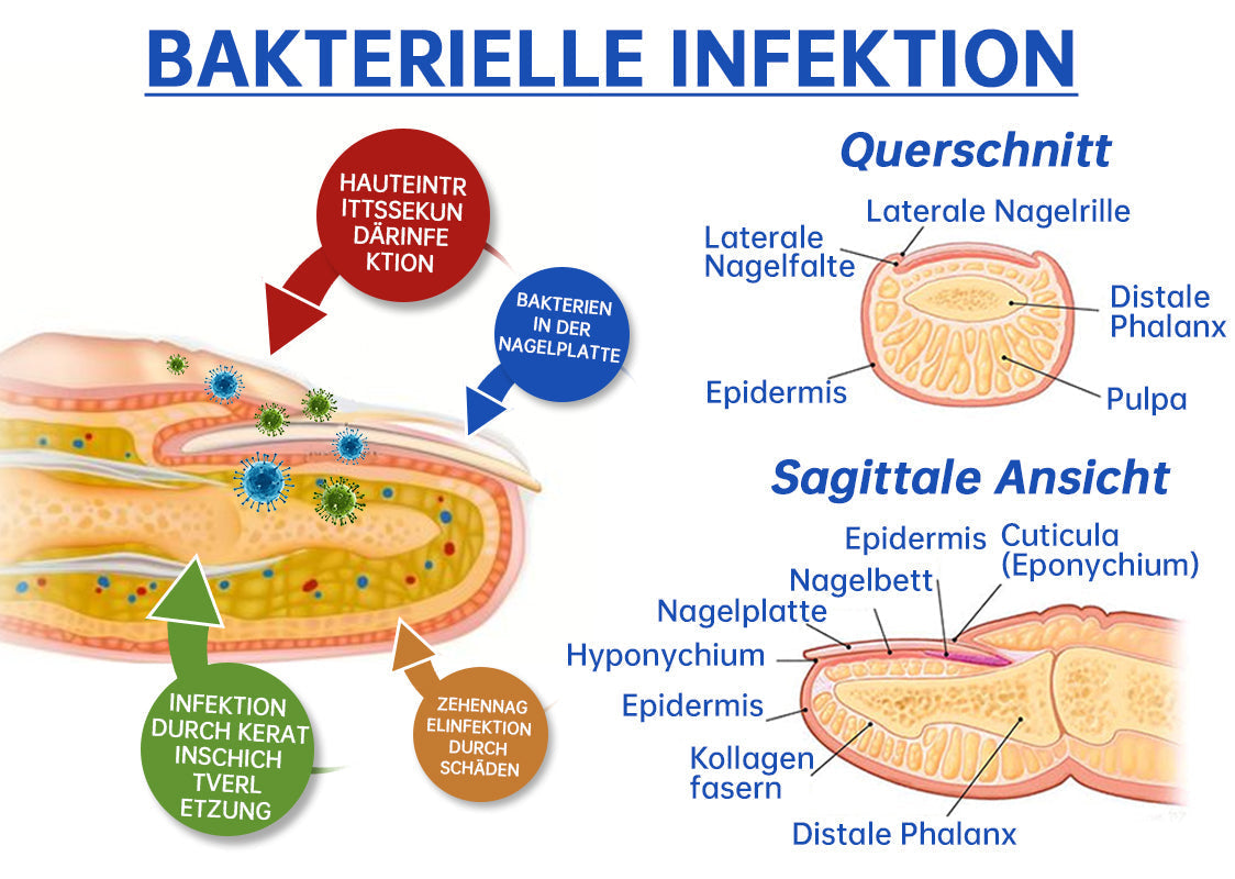 Norvo | PureNail™ | Neglesopp Laserbehandling Enhet - Ditt hemmelige våpen mot neglesopp