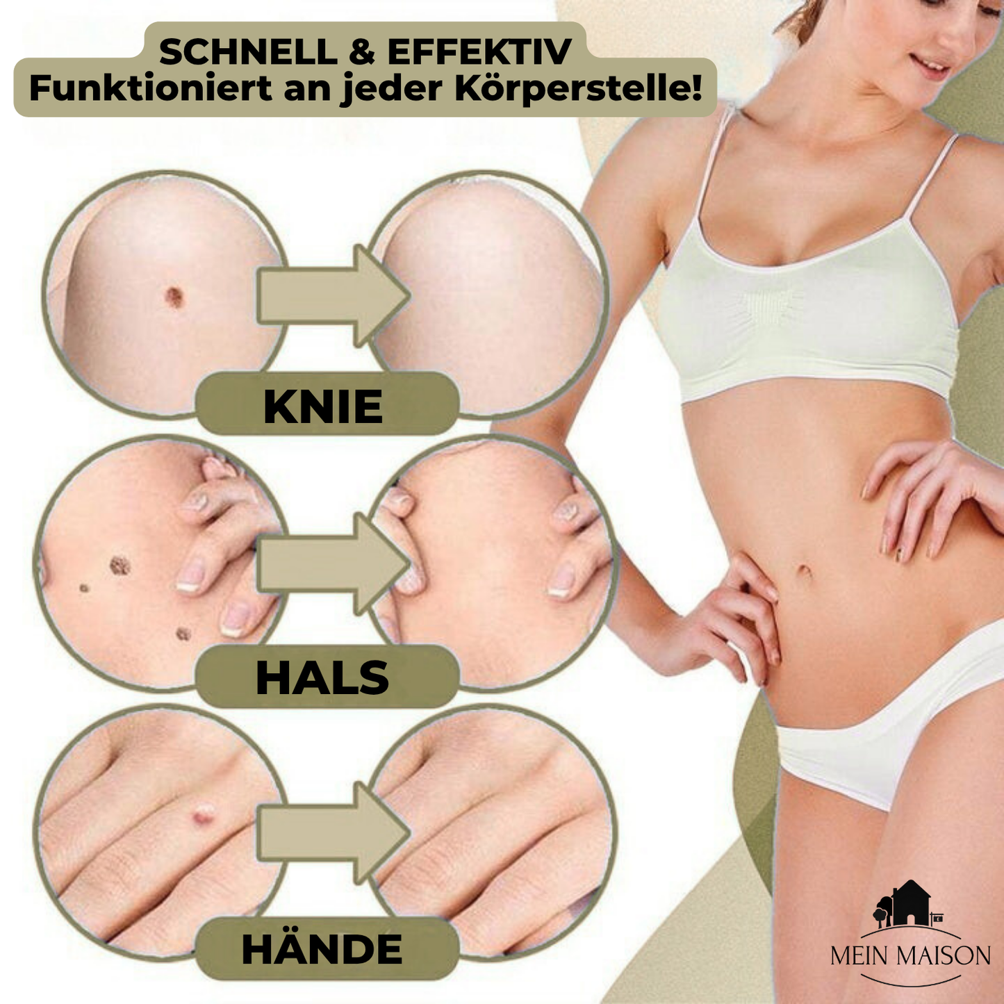 Norvo | DermaLinx Vortefjerner | Smertfri fjerning av vorter og føflekker | For hjemme | Uten kirurgi