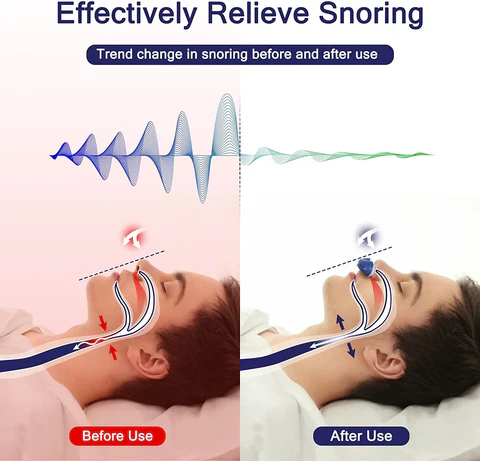 Norvo | Anti Snoring Nose Clip for Better Sleep