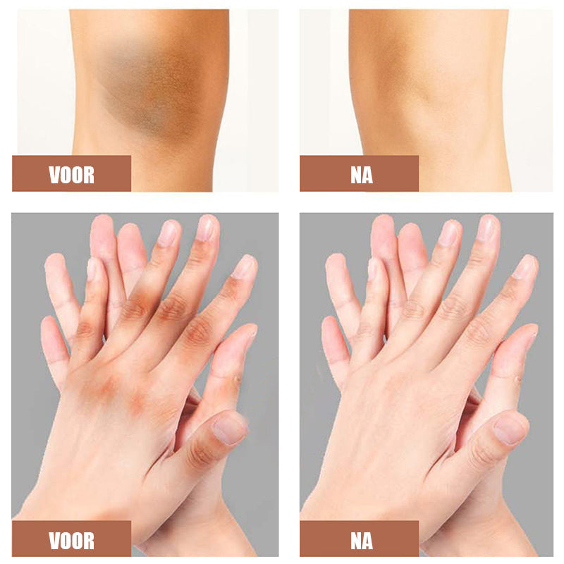 Norvo | Kne og albuer sterk blekemiddel krem