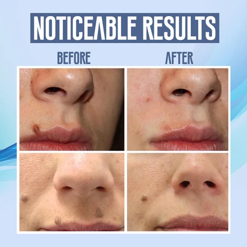 Norvo | Ansikts hårfjerning penn