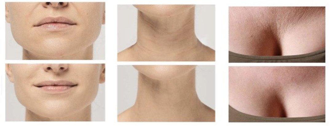 Norvo | Anti-rynke silikonputer