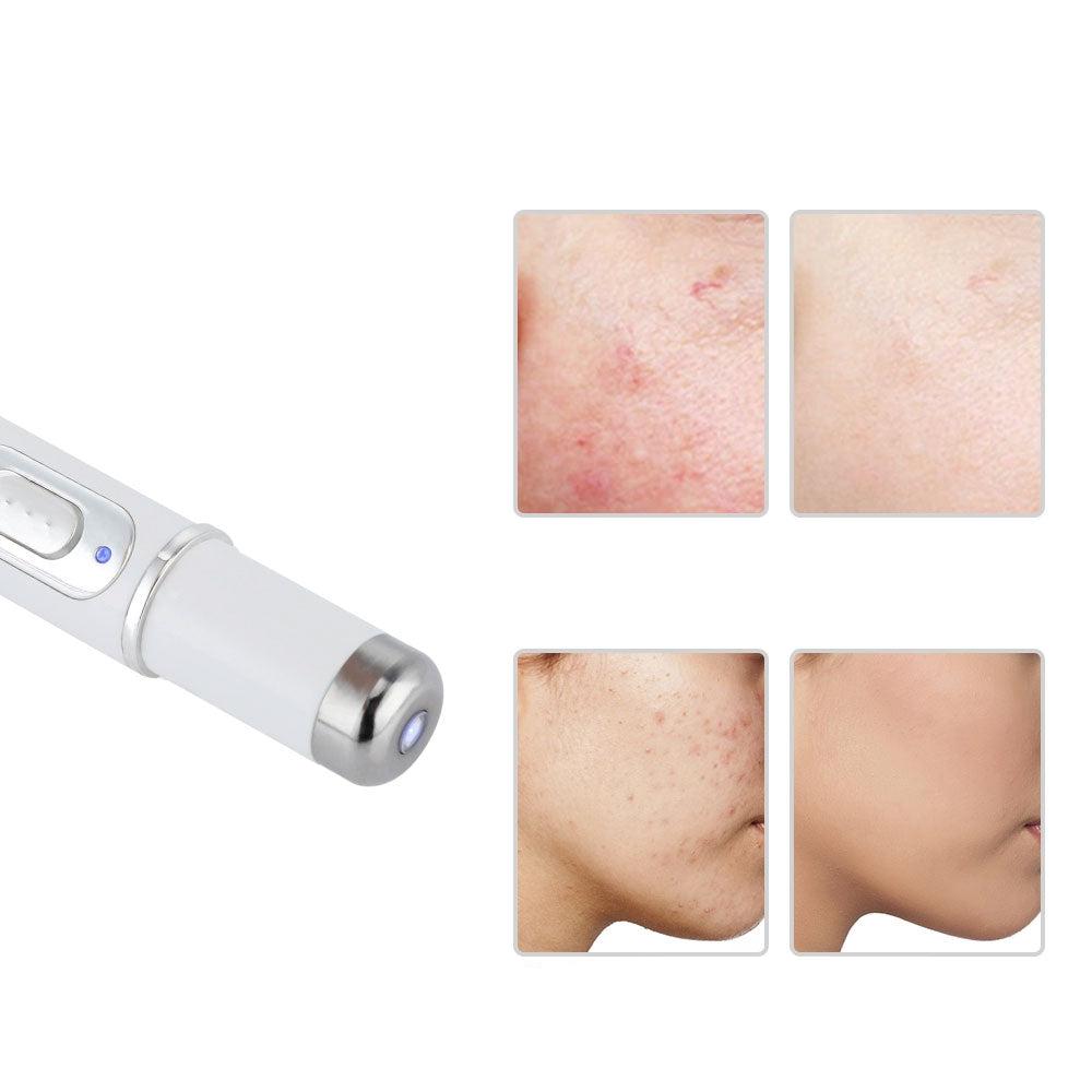 Norvo | LUCY – Laserpen med blått lys for presis behandling