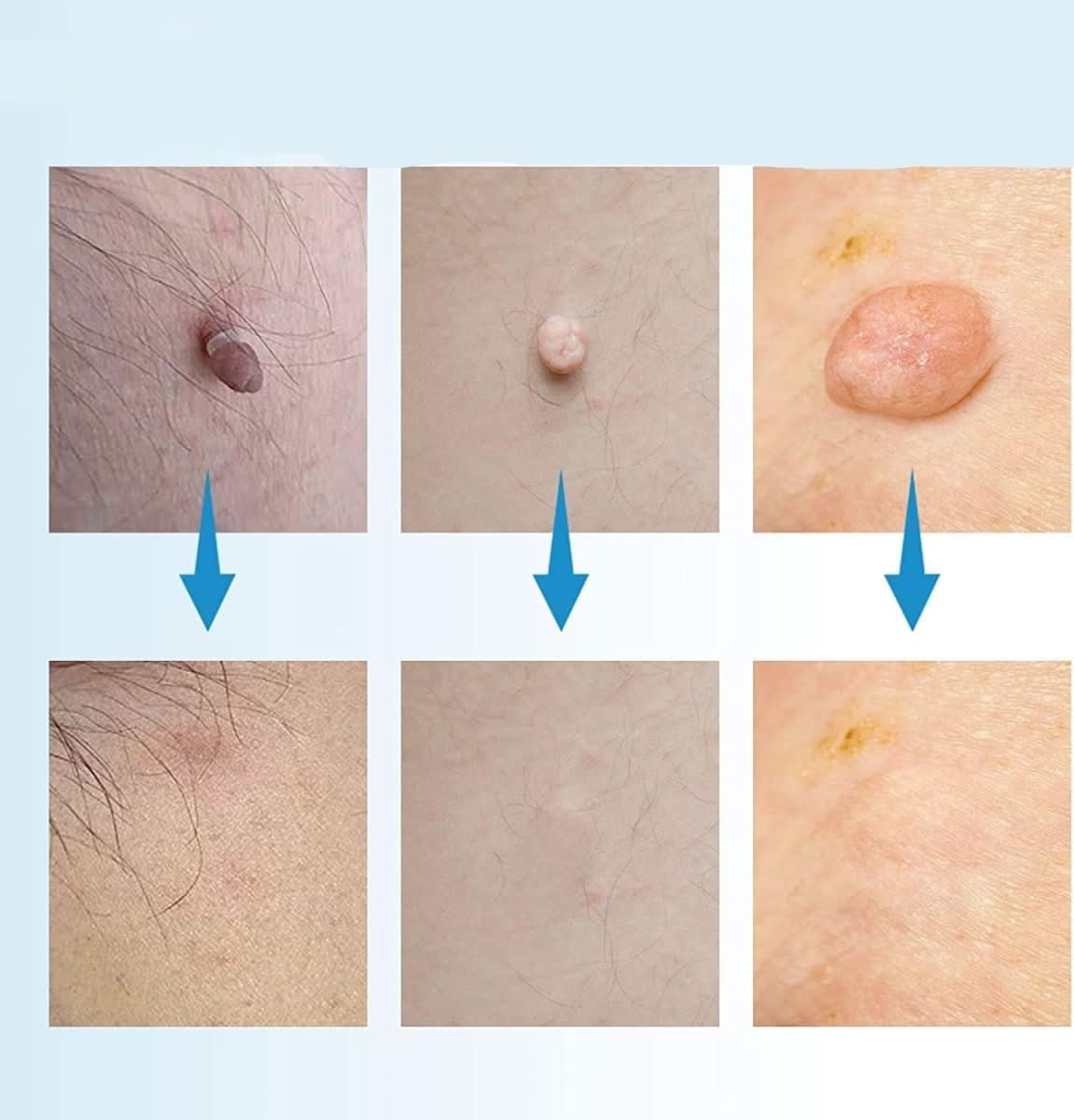 Norvo | DERMASWIFT – Hudflekkfjerner for Vorter & Hudflikter