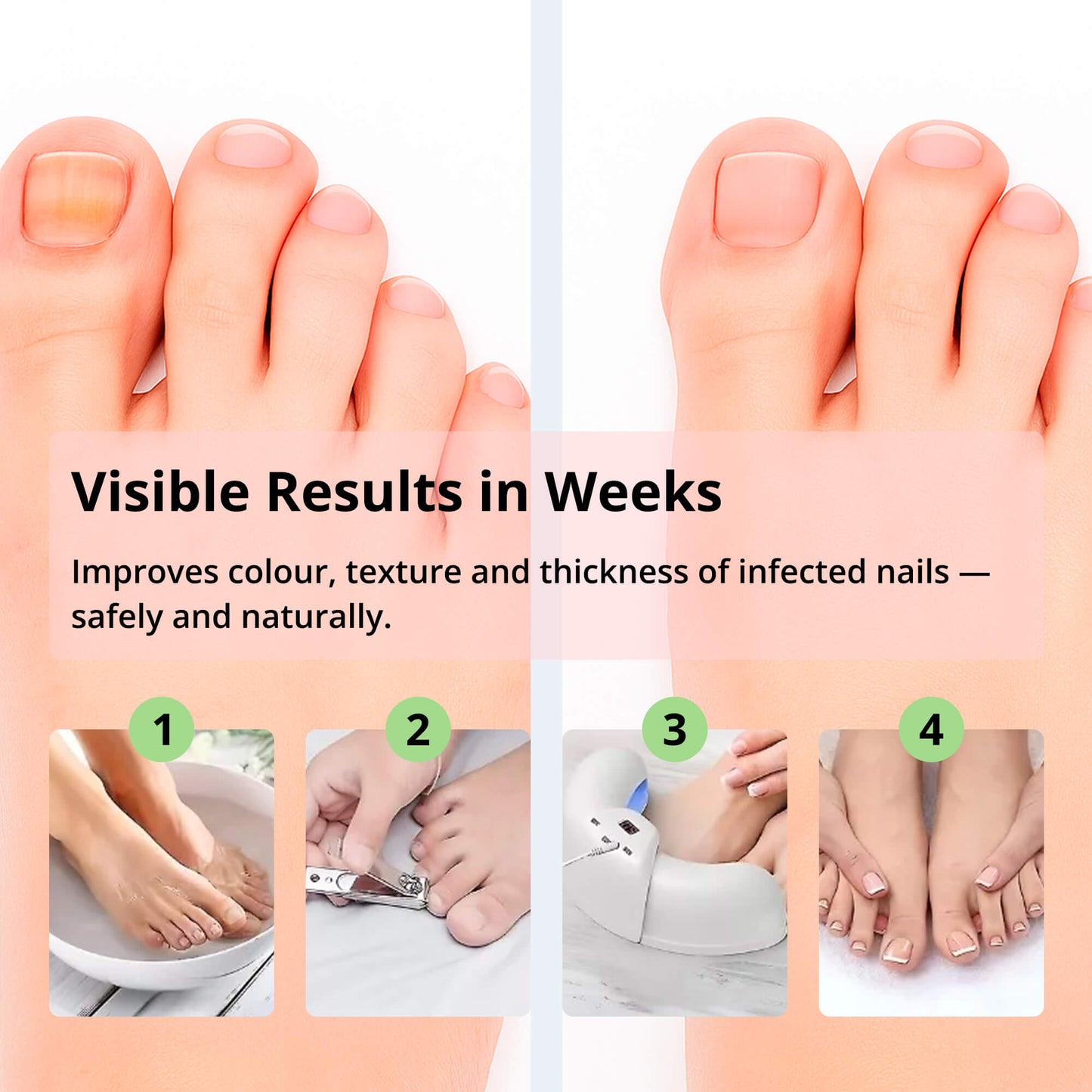 Norvo | Laser Soppfjerning av Negler Enhet | Avansert Hjemmebehandling med Rødt & Blått Lys for Sunne Negler