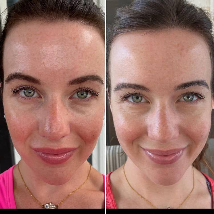 Norvo | LED Ansiktsmaske Lysbehandling Hudpleie Enhet