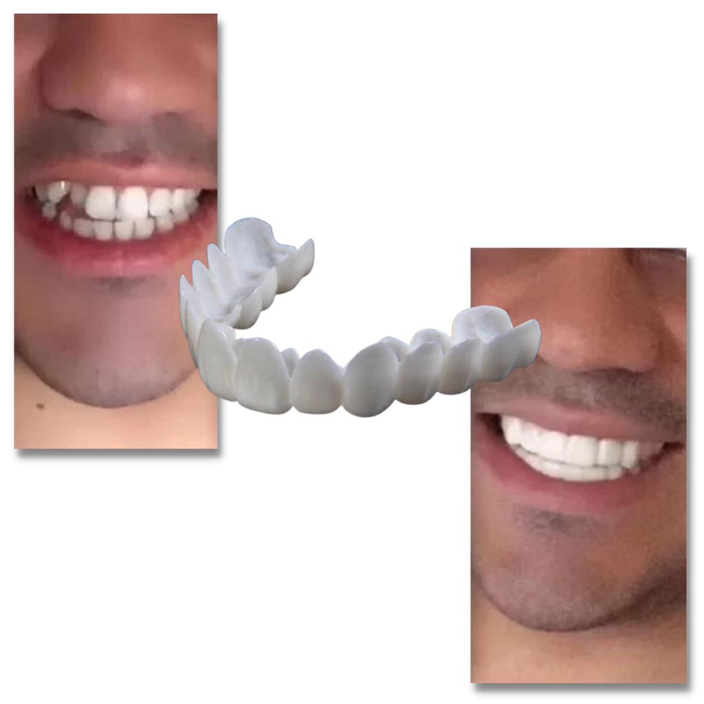 Perfekt smil tanndekning - komfortable finér