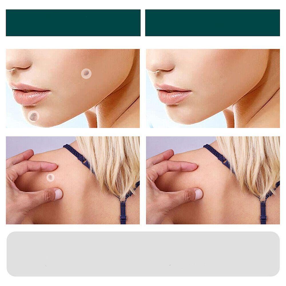 Norvo | SkinClear - Plaster for the removal of spots and warts