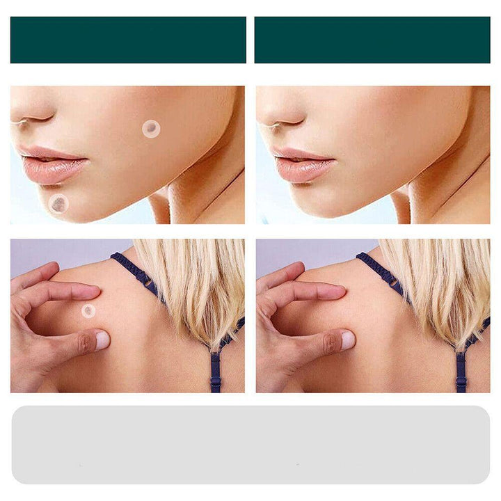 Norvo | SkinClear - Plaster for the removal of spots and warts