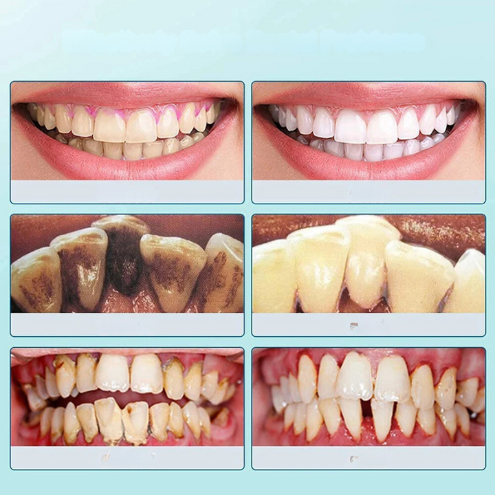 Norvo | SmilePro Ultrasonisk Tannsteinfjerner – Effektiv Plakkfjerner for Hjemmet