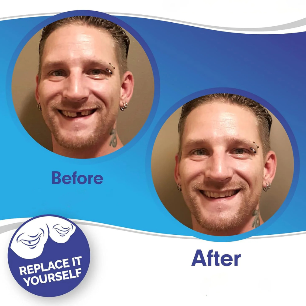 Norvo | Avtagbare Fyllinger Tanndekke