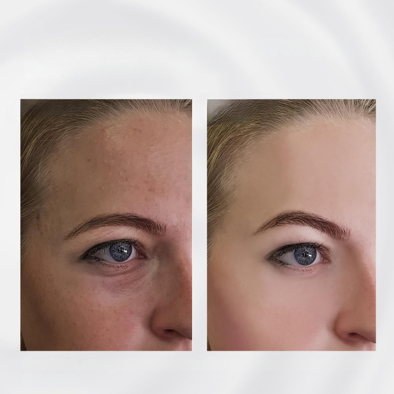 Norvo | Ansiktsrulle i rustfritt stål for hevelse massasjer