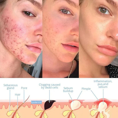 Norvo | Elysium Glow™ | Profesjonell høyfrekvent ansiktsstang | Anti-aldring hudforyngelsesapparat for hjemmebruk og spa-behandlinger