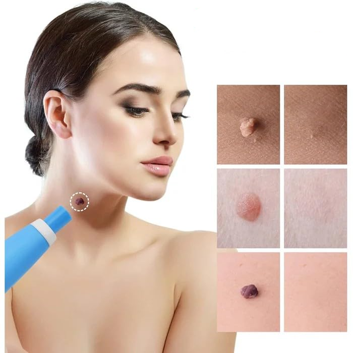 Skin Tag Remover Kit | Ikke-invasiv & Effektiv | Norvo