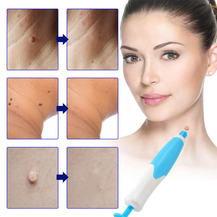 Skin Tag Remover Kit | Ikke-invasiv & Effektiv | Norvo