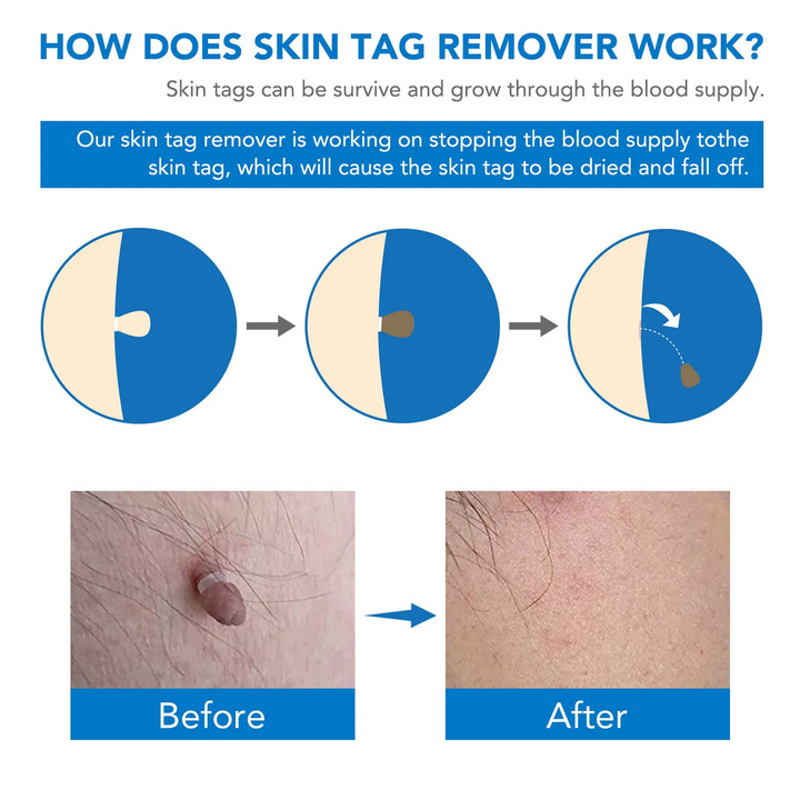 Skin Tag Remover Kit | Ikke-invasiv & Effektiv | Norvo