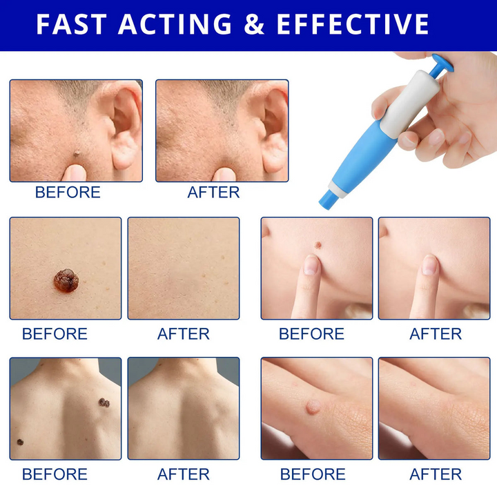 Skin Tag Remover Kit | Ikke-invasiv & Effektiv | Norvo