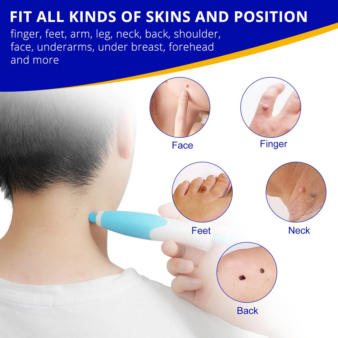 Skin Tag Remover Kit | Ikke-invasiv & Effektiv | Norvo