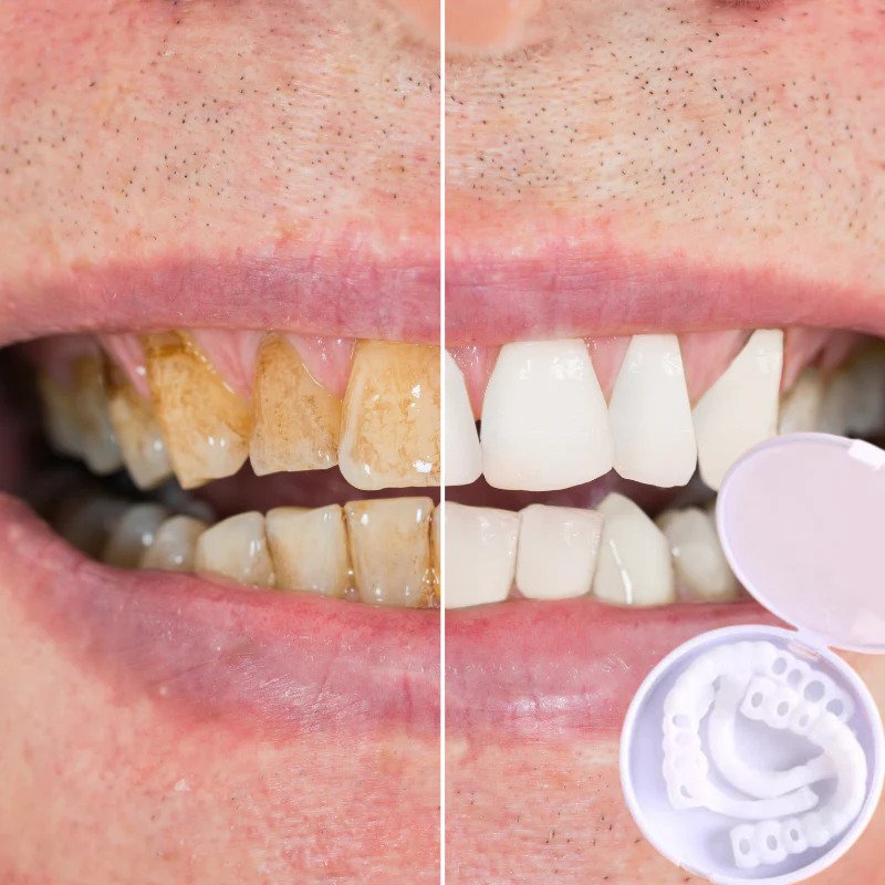 Norvo | Snap-on Teeth™ - Med disse fasettene, ha alltid det perfekte smilet