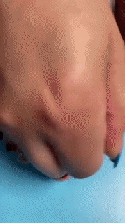 Norvo | Fleksibel ortopedisk hallux valgus-korrektor