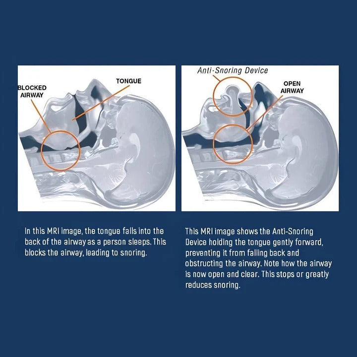 Norvo | Silikon Tunge Posisjonering Enhet for Nattetid Komfort