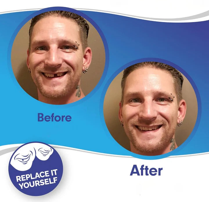 Norvo | Avtagbare Smile Veneers for Øvre og Nedre Tenner