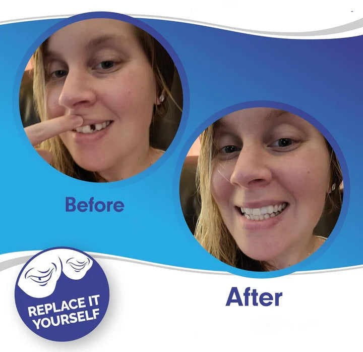 Norvo | Avtagbare Smile Veneers for Øvre og Nedre Tenner