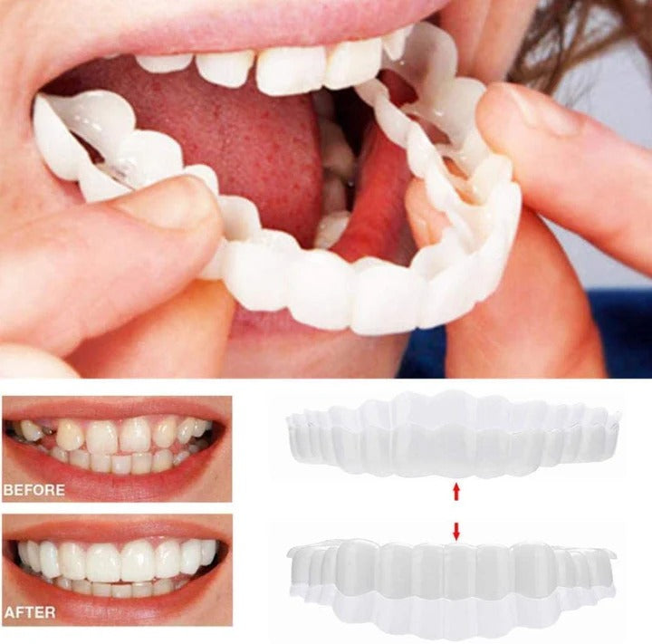 Norvo | Avtagbare Smile Veneers for Øvre og Nedre Tenner