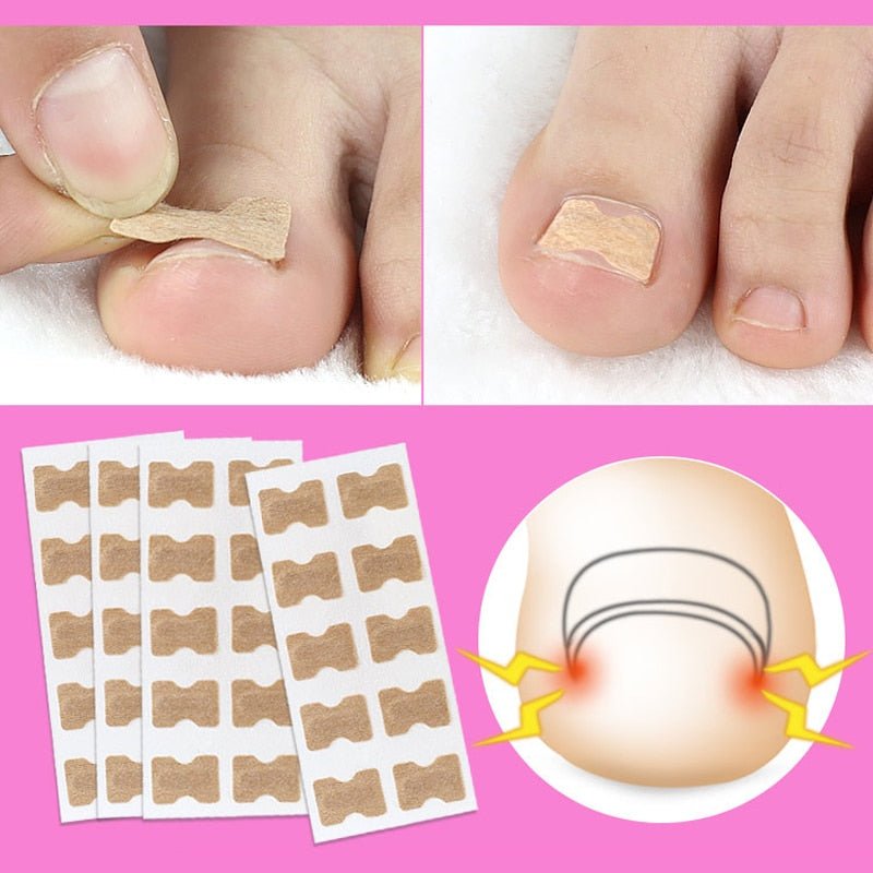 Norvo | Painless Toenail Patch - ToenailExpress