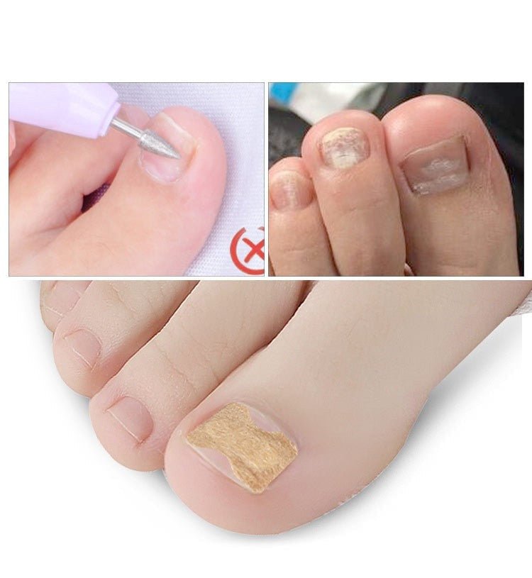 Norvo | Painless Toenail Patch - ToenailExpress