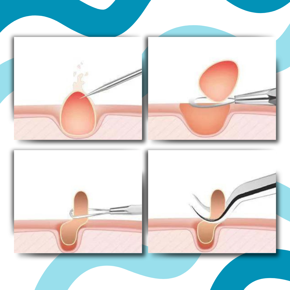 Ultrapresis spiss pinsett